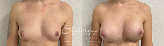 Before & After Breast Augmentation Case 875 Front View in Austin, TX