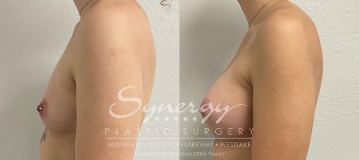 Before & After Breast Augmentation Case 875 Right Side View in Austin, TX