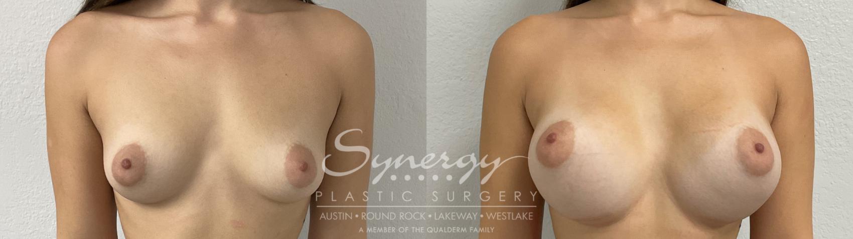 Before & After Breast Augmentation Case 876 Front View in Austin, TX