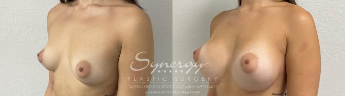 Before & After Breast Augmentation Case 876 Right Oblique View in Austin, TX
