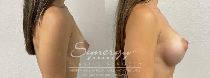 Before & After Breast Augmentation Case 876 Right Side View in Austin, TX
