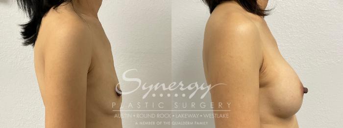 Before & After Breast Augmentation Case 878 Left Side View in Austin, TX