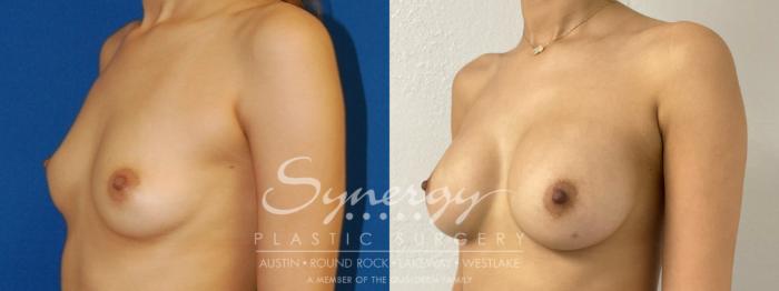 Before & After Breast Augmentation Case 880 Right Oblique View in Austin, TX