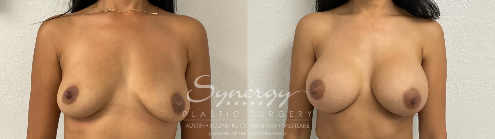 Before & After Breast Augmentation Case 884 Front View in Austin, TX