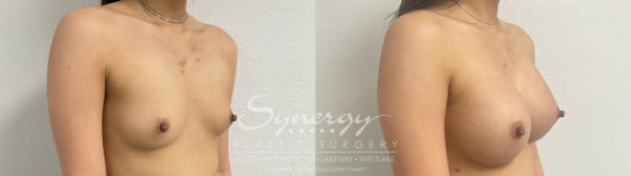 Before & After Breast Augmentation Case 887 Left Oblique View in Austin, TX