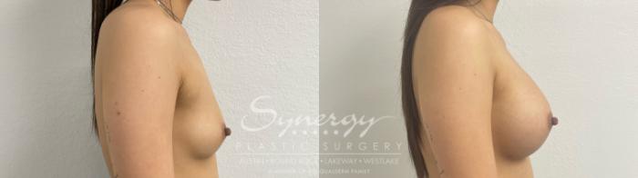 Before & After Breast Augmentation Case 887 Left Side View in Austin, TX