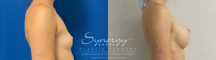 Before & After Breast Augmentation Case 895 Right Side View in Austin, TX