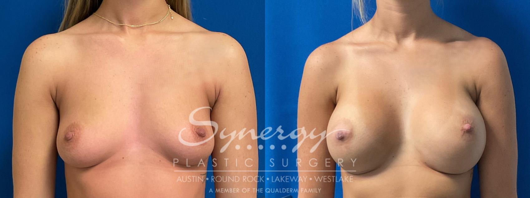 Before & After Breast Augmentation Case 906 Front View in Austin, TX