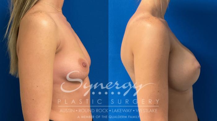 Before & After Breast Augmentation Case 906 Right Side View in Austin, TX