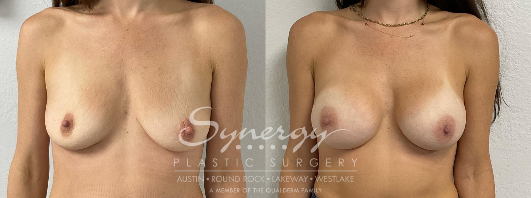 Before & After Breast Augmentation Case 915 Front View in Austin, TX