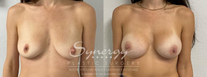 Before & After Breast Augmentation Case 915 Front View in Austin, TX
