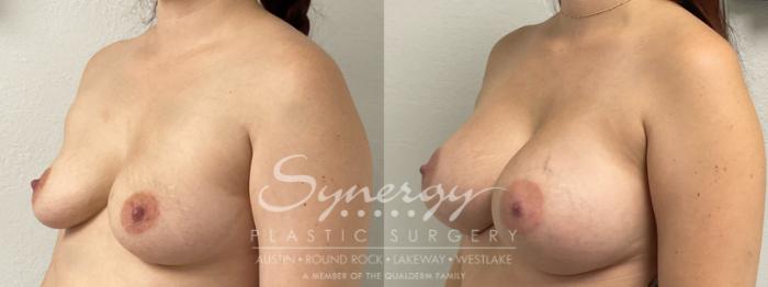 Before & After Breast Augmentation Case 917 Left Oblique View in Austin, TX
