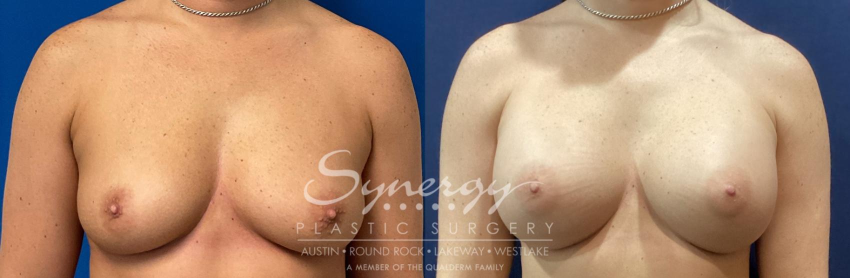 Before & After Breast Augmentation Case 923 Front View in Austin, TX
