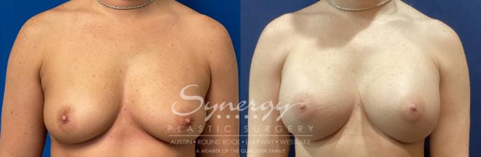 Before & After Breast Augmentation Case 923 Front View in Austin, TX