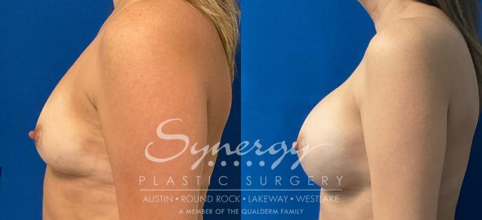 Before & After Breast Augmentation Case 928 Left Side View in Austin, TX