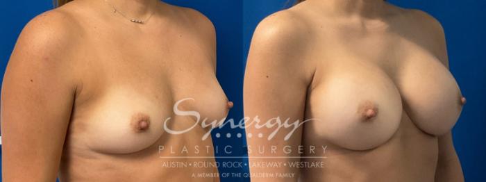 Before & After Breast Augmentation Case 928 Right Oblique View in Austin, TX