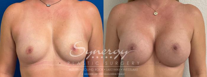 Before & After Breast Augmentation Case 929 Front View in Austin, TX