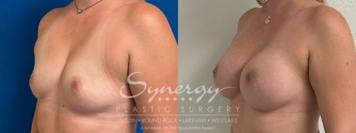 Before & After Breast Augmentation Case 929 Left Oblique View in Austin, TX