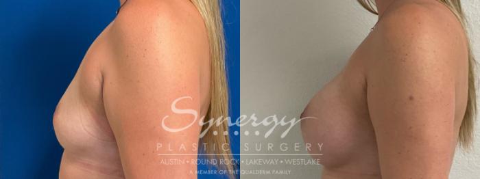 Before & After Breast Augmentation Case 929 Left Side View in Austin, TX