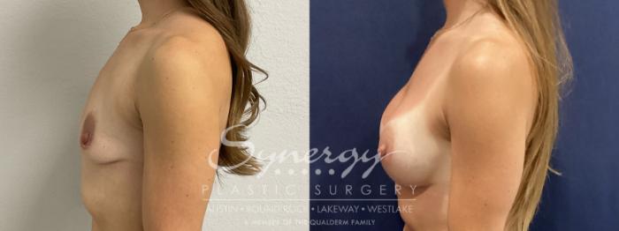 Before & After Breast Augmentation Case 931 Left Side View in Austin, TX