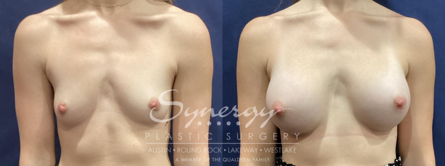 Before & After Breast Augmentation Case 934 Front View in Austin, TX