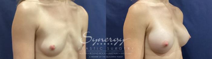 Before & After Breast Augmentation Case 934 Right Oblique View in Austin, TX