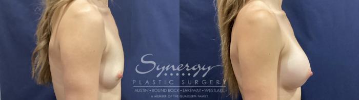 Before & After Breast Augmentation Case 934 Right Side View in Austin, TX