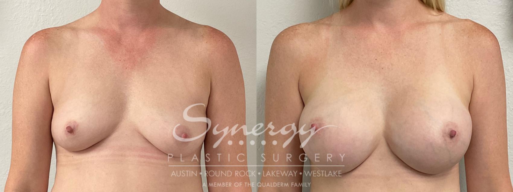Before & After Breast Augmentation Case 936 Front View in Austin, TX