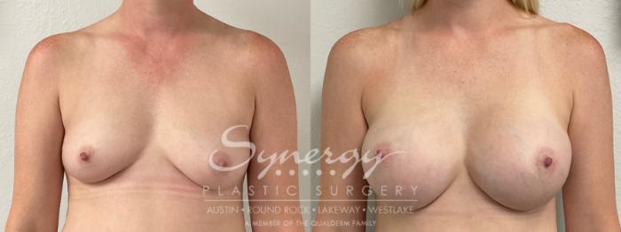 Before & After Breast Augmentation Case 936 Front View in Austin, TX