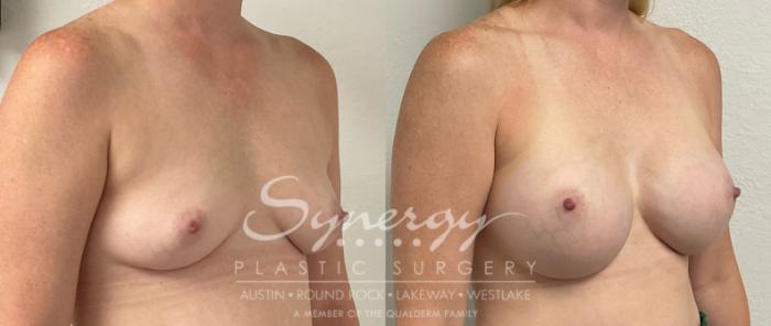 Before & After Breast Augmentation Case 936 Right Oblique View in Austin, TX