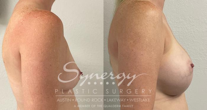 Before & After Breast Augmentation Case 936 Right Side View in Austin, TX
