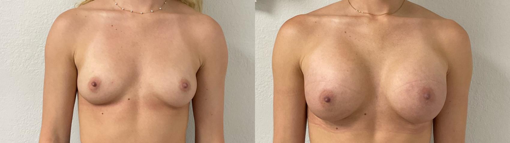 Before & After Breast Augmentation Case 939 Front View in Austin, TX
