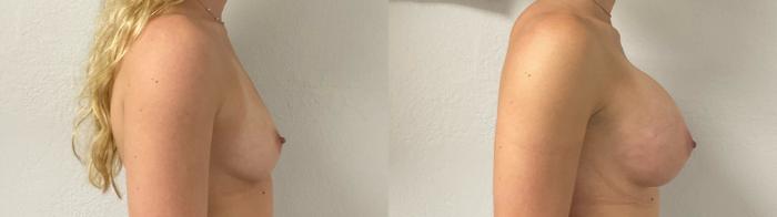 Before & After Breast Augmentation Case 939 Right Side View in Austin, TX