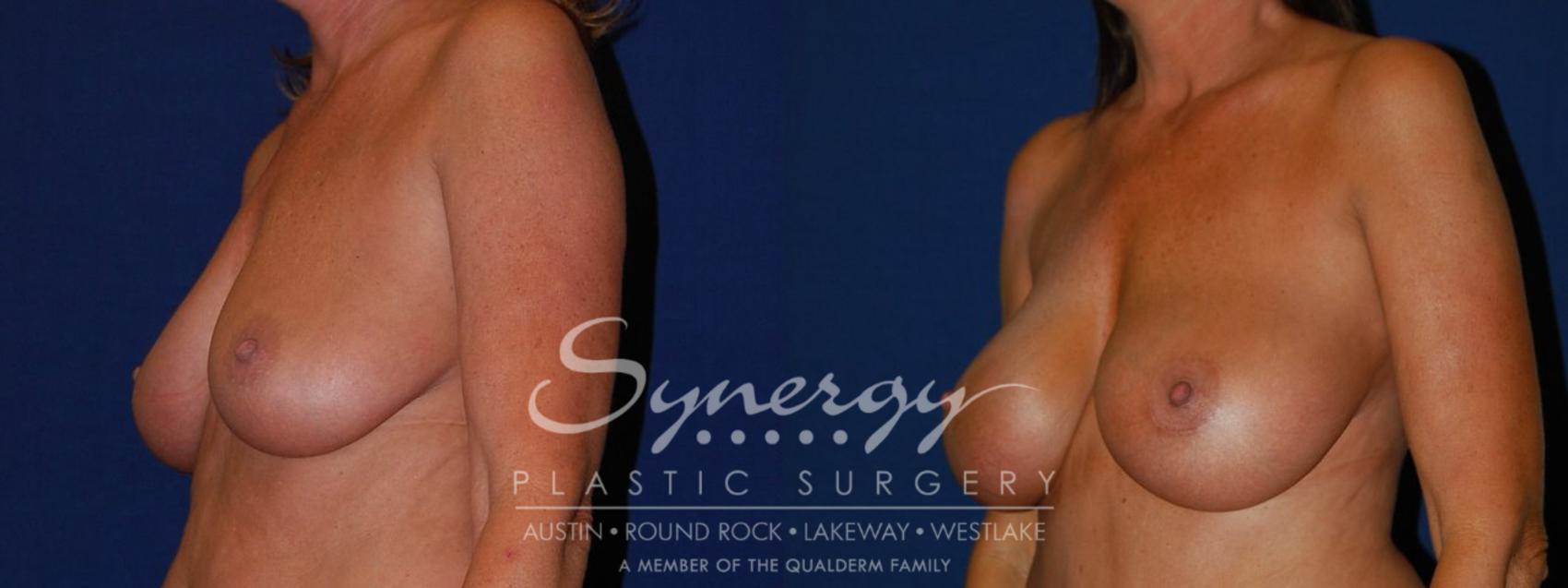 Before & After Breast Augmentation Case 94 View #1 View in Austin, TX