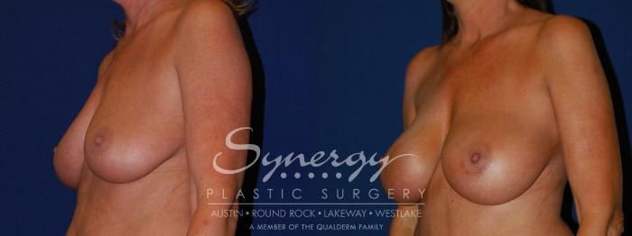 Before & After Breast Augmentation Case 94 View #1 View in Austin, TX