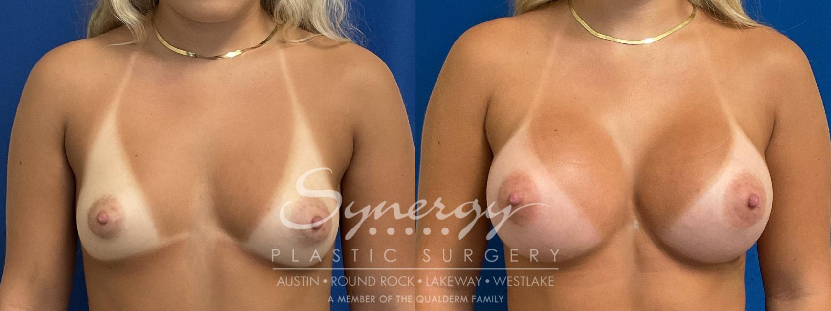 Before & After Breast Augmentation Case 940 Front View in Austin, TX