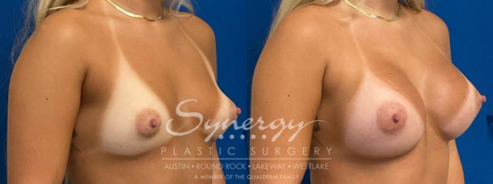 Before & After Breast Augmentation Case 940 Right Oblique View in Austin, TX