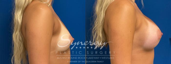 Before & After Breast Augmentation Case 940 Right Side View in Austin, TX
