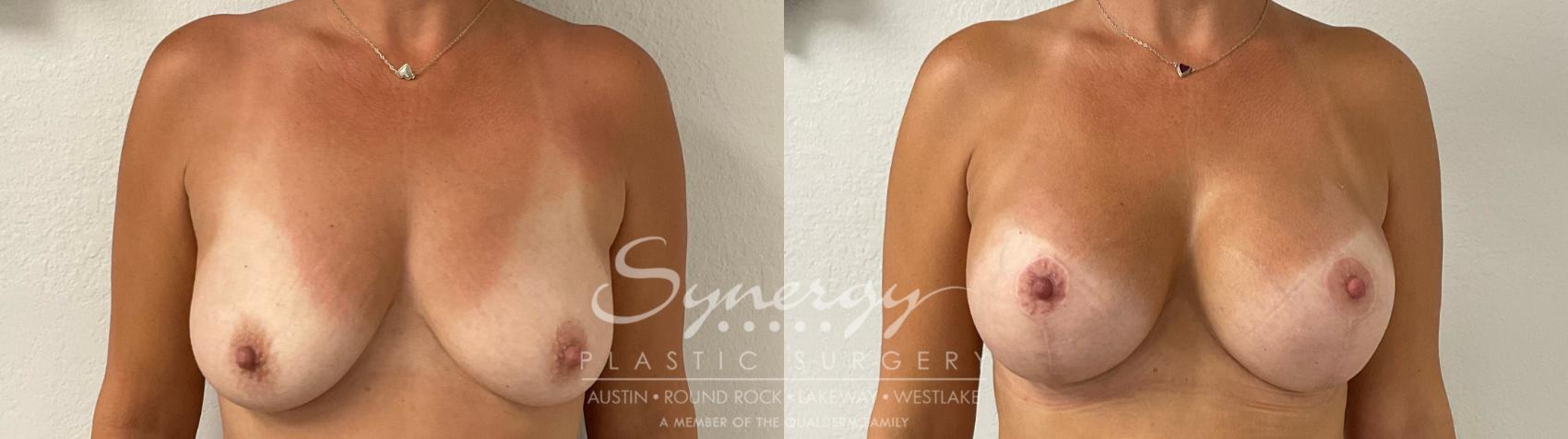 Before & After Breast Augmentation Case 943 Front View in Austin, TX