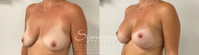 Before & After Breast Augmentation Case 943 Left Oblique View in Austin, TX