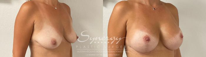 Before & After Breast Augmentation Case 943 Right Oblique View in Austin, TX