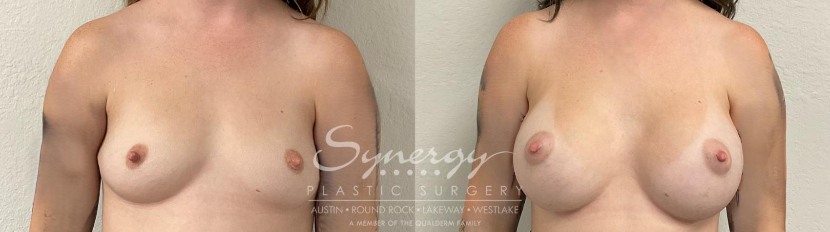 Before & After Breast Augmentation Case 945 Front View in Austin, TX