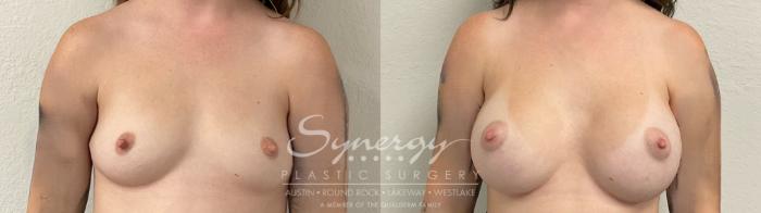 Before & After Breast Augmentation Case 945 Front View in Austin, TX