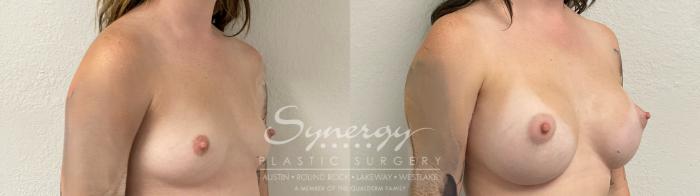 Before & After Breast Augmentation Case 945 Right Oblique View in Austin, TX