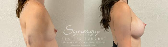 Before & After Breast Augmentation Case 945 Right Side View in Austin, TX