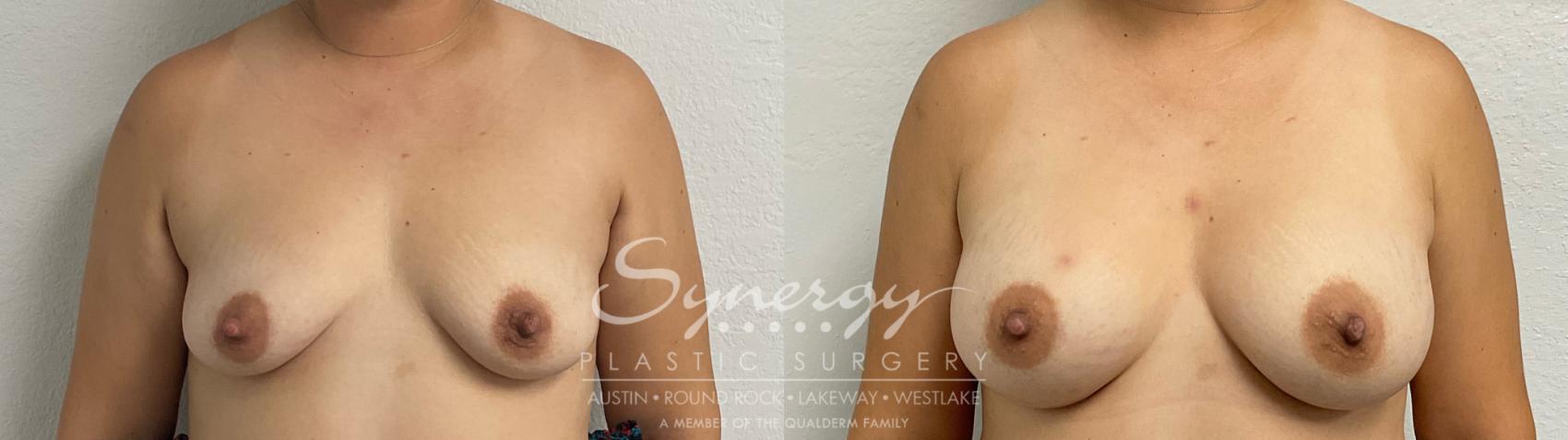 Before & After Breast Augmentation Case 946 Front View in Austin, TX