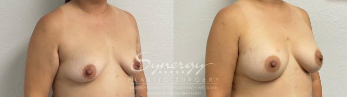 Before & After Breast Augmentation Case 946 Right Oblique View in Austin, TX