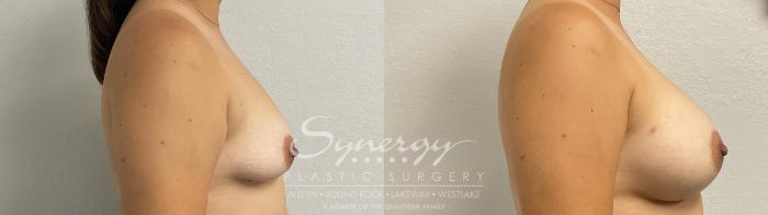 Before & After Breast Augmentation Case 946 Right Side View in Austin, TX