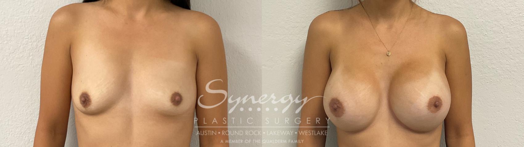 Before & After Breast Augmentation Case 951 Front View in Austin, TX