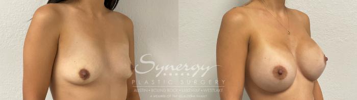 Before & After Breast Augmentation Case 951 Right Oblique View in Austin, TX